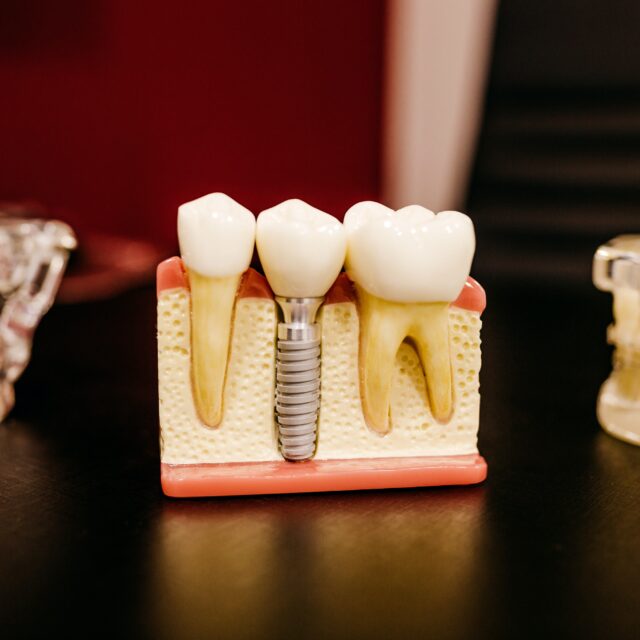 https://dentalboutique.bg/wp-content/uploads/2023/01/implantologiya-640x640.jpg